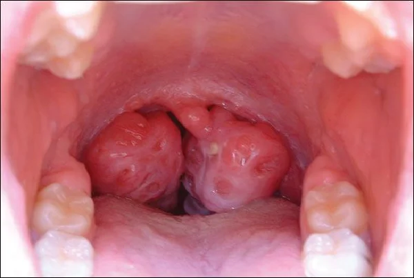 Tonsillectomy