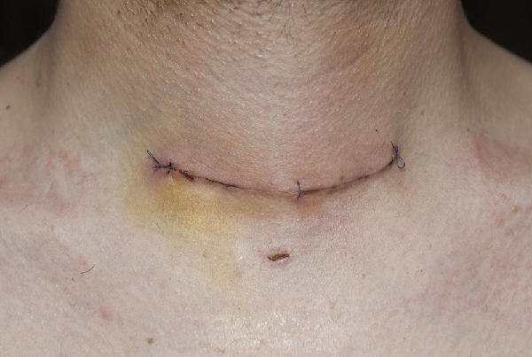 Thyroidectomy