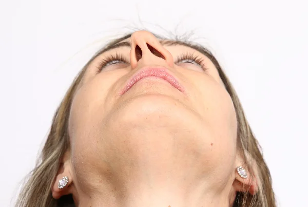 Deviated Nasal Septum