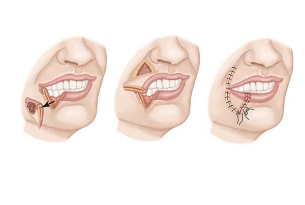Oral Cancer