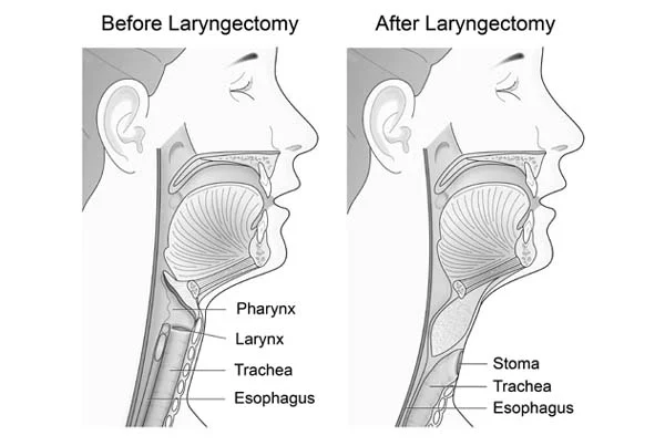 Laryngectomy